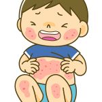 アトピー性皮膚炎と他の湿疹の見分け方